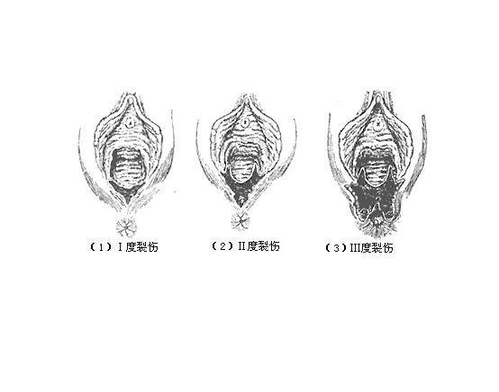 软产道裂伤