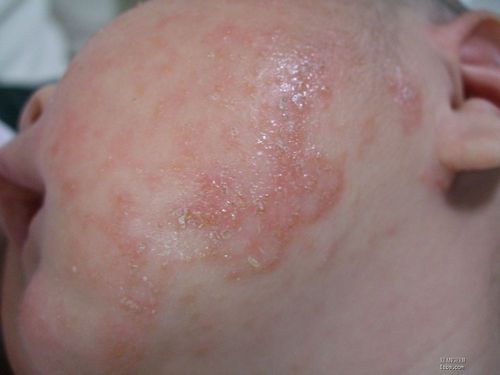 婴儿湿疹奶癣宝宝之父母湿疹手册-低敏奶粉大全-添激素排行榜