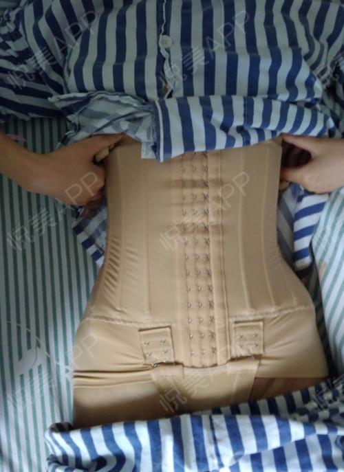 激光溶脂瘦腰腹术后2天_吸脂瘦腰腹术后2天_水动力吸脂瘦腰腹术后2天