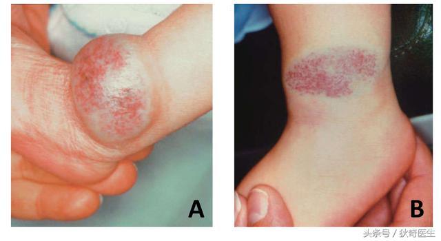 血管瘤系列科普之三,什么样的血管瘤可以不治疗?
