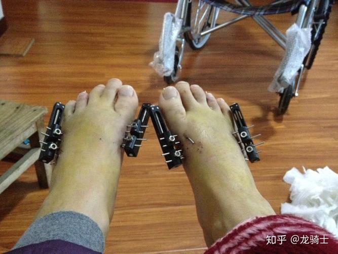 我的脚趾短小治疗经历分享第一四跖骨短小