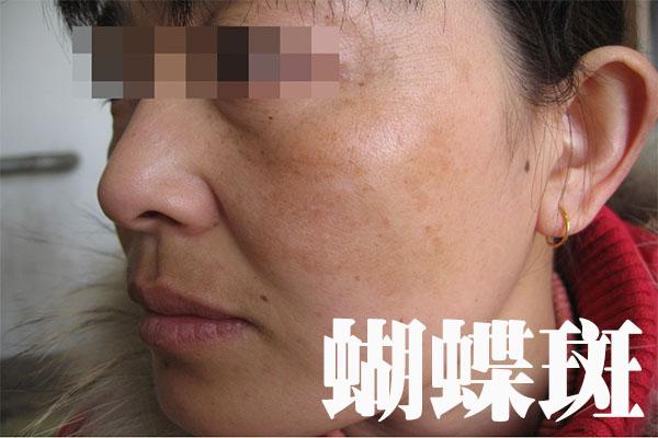 很多两面对称似蝴蝶翅膀又被称为蝴蝶斑,本病多见于妊娠期所以又有人