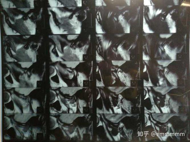 现在还没好呢,有懂的知友们帮忙看看核磁共振图