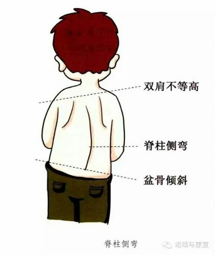 关注青少年儿童脊柱健康 不要让孩子累倒在起跑线上!