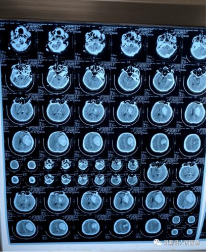 入院后第一次复查颅脑ct及胸部ct片