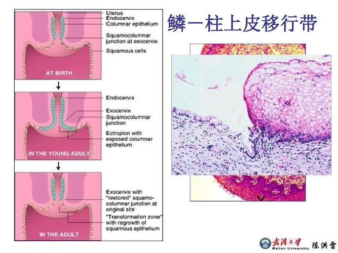 鳞-柱上皮移行带