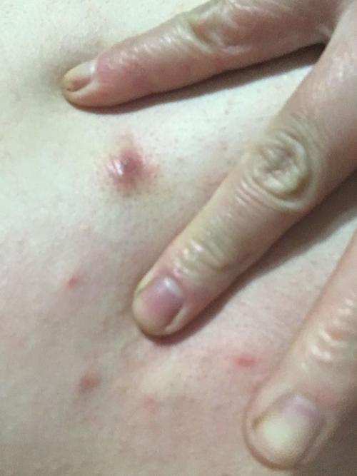 胸前起个痘痘 挤出来血里有白色渣渣 这是疥疮吗?