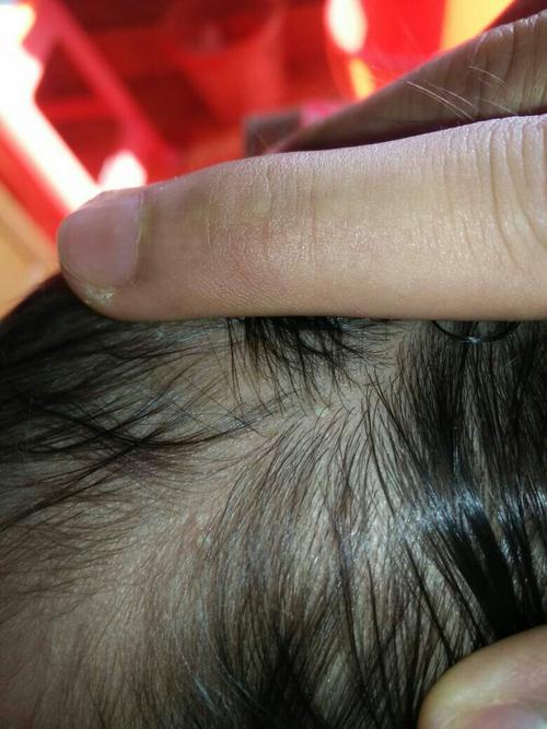 宝宝头上长一个个黄色的像脓包一样的东西是什么怎么办