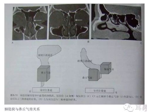 额隐窝于鼻丘气房