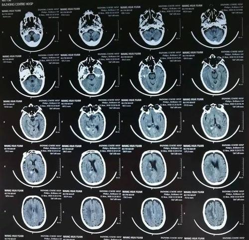 术后20天复查头颅ct基本正常