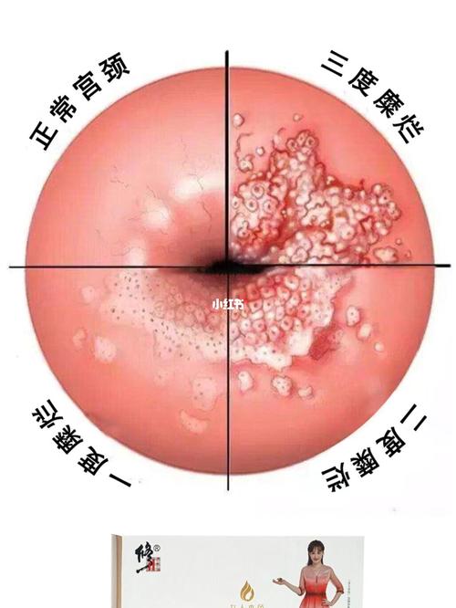 9899宫颈糜烂 症状:由慢性宫颈炎引起,白带量多,色黄脓样或黄色