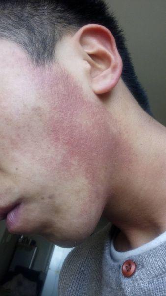 求助各位皮肤病大师 我脸上的毛周角化怎么才能只好,不红也行!