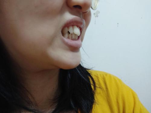 感觉主要问题是门牙歪掉了,别的也没什么大问题,想去带牙套,但也不