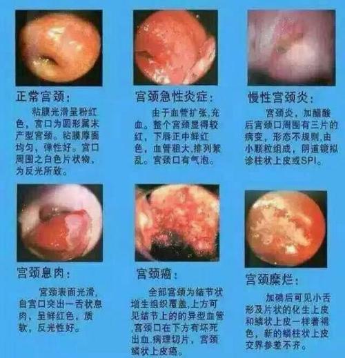 宫颈炎和宫颈糜烂是怎么回事
