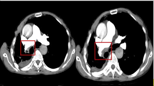 肺栓塞ct增强的解析ppt件ppt课件