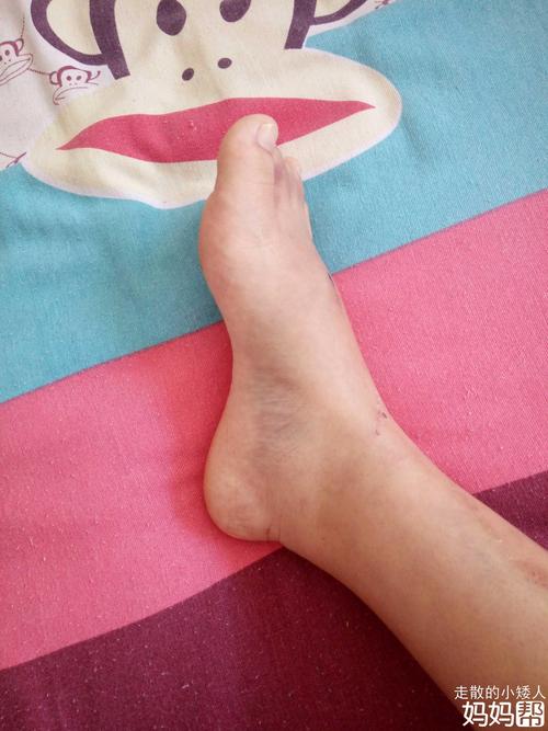 脚肿是多走动消肿效果快还是不走动消肿效果快?