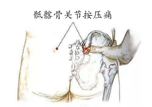 什么是骶髂骨关节炎,有哪些症状,如何治疗?