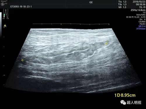 小腿静脉解剖的超声图文分步解读