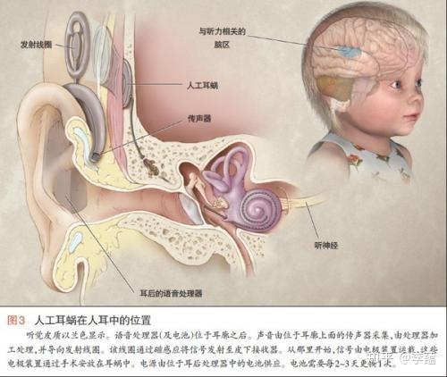 科普人工耳蜗