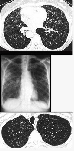 更新                 a  粟粒性肺结核 b  含铁血黄素沉着 c  弥漫