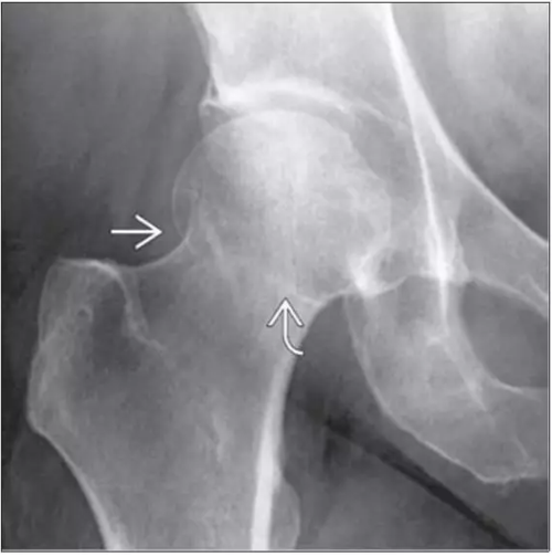 一文详解急诊影像诊断学之股骨颈骨折,干货get!