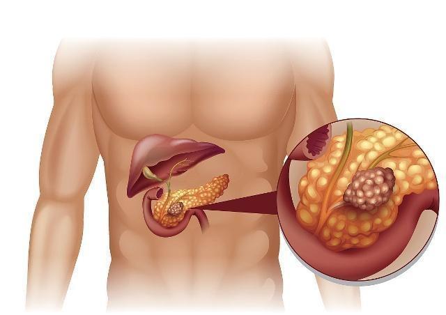 身体发出这3个"信号",可能是胰腺"癌变"了,希望你一个没有