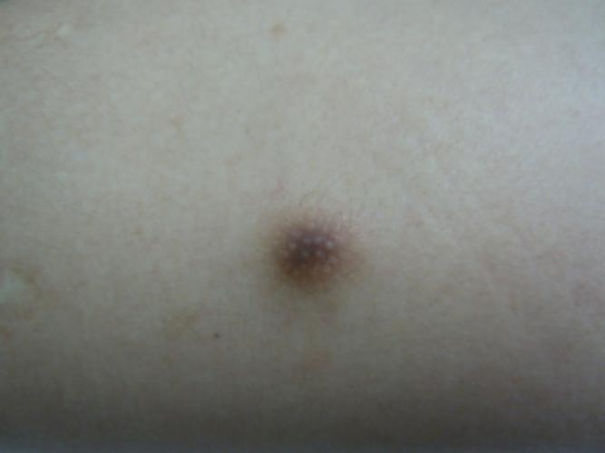 如何正确认识皮肤良性肿瘤?