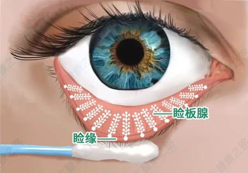 什么是睑板腺功能障碍?如何缓解? - 健康驱动力