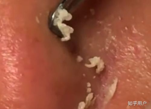 痤疮和粉刺里挤出来的到底是什么?