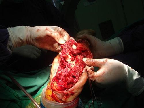 20121211急诊行清创术,见右肘击前臂软组织裂开,大片肌肉坏死,桡神经