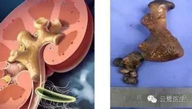 小结石顶多包床;较大的结石占据整个肾盏,叫做包房;鹿角形结石绝了