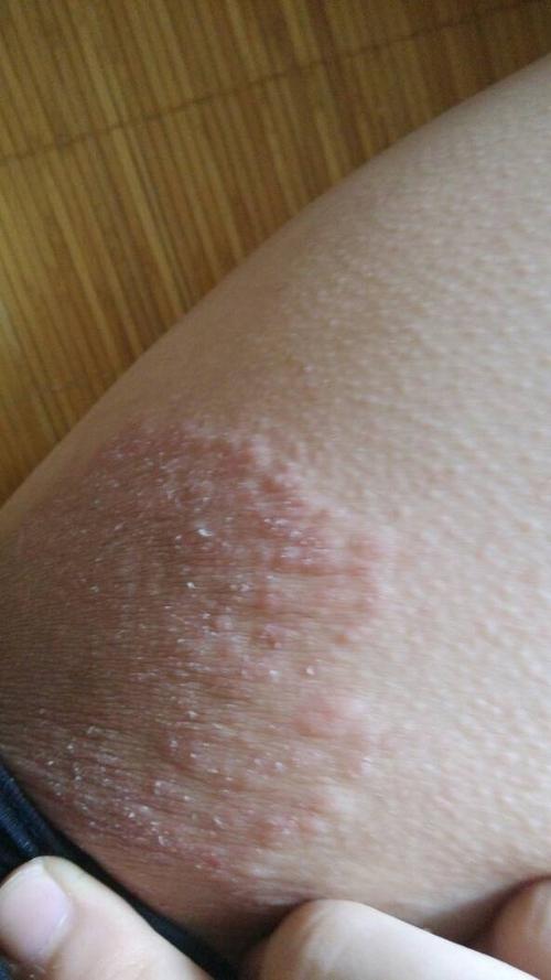 问:大腿内侧阴囊旁边有红斑,如何医治?