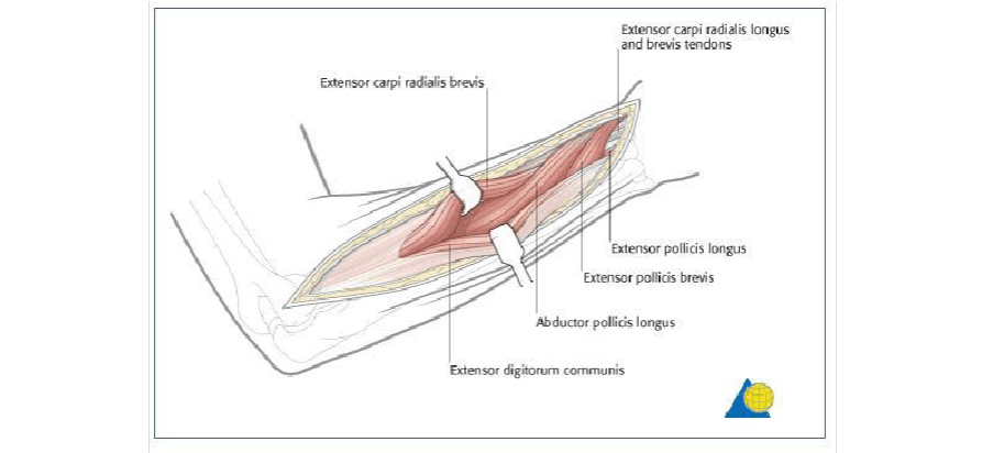 桡骨背外侧手术入路(thompson入路)