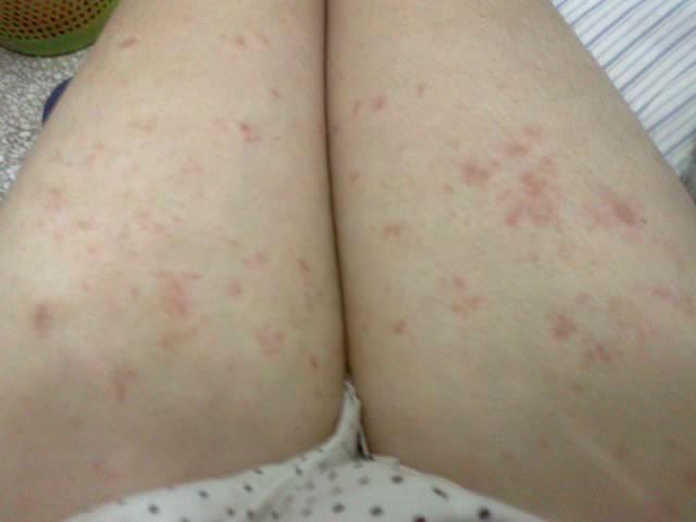 你好,我大腿两边长了很多一片一片红的