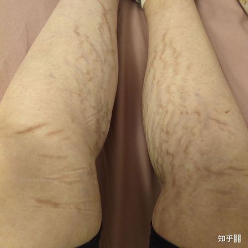 这样的肥胖纹是哪个时期,是不是没救了?