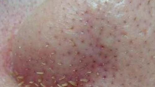鼻子周围隔一两周就能挤出很多分泌物,是螨虫吗?