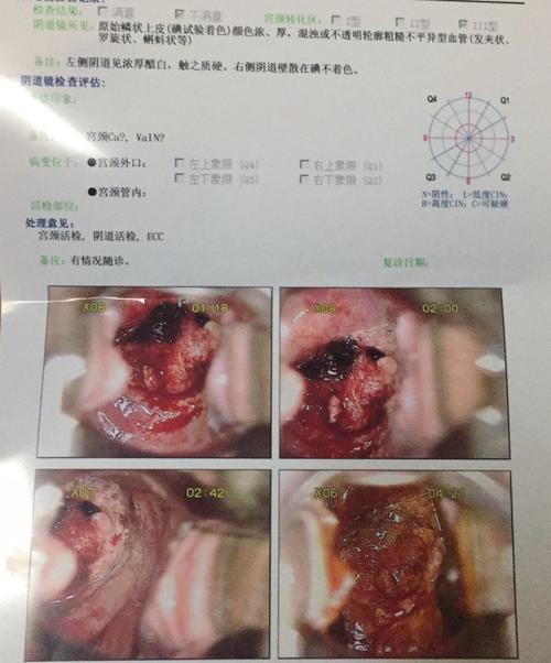 阴道镜检查可见异形血管,碘不着色,浓醋白,宫颈转化区Ⅲ型(详见照片)