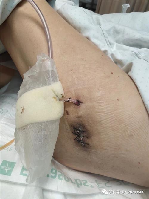 术后12天,拔引流负压球引流管.
