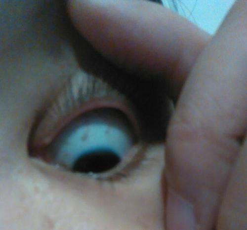 眼睛里面有血丝,还带着黑点,眼睛感觉累累的,是怎么回事呢!用点眼