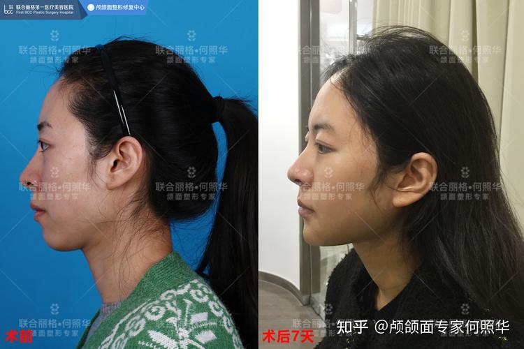 侧脸很宽是什么原因