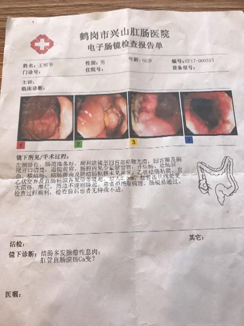 直肠齿状线恶性肿瘤必须做改道手术吗?