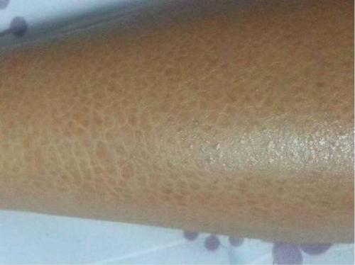 与汗疱疹这种烦人的小妖精不同,鱼鳞病要安分得多—— 虽然难看,但