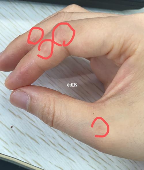 换季手上出湿疹_湿疹_成人湿疹_医疗健康_医疗药品