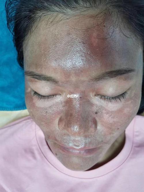 真皮斑第一期:脸颊 真皮斑第二期:太阳穴 真皮斑第三期:额头_护肤_美