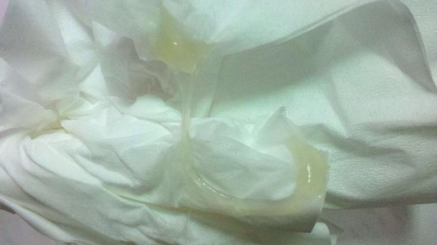 这样的白带是脓性白带吗