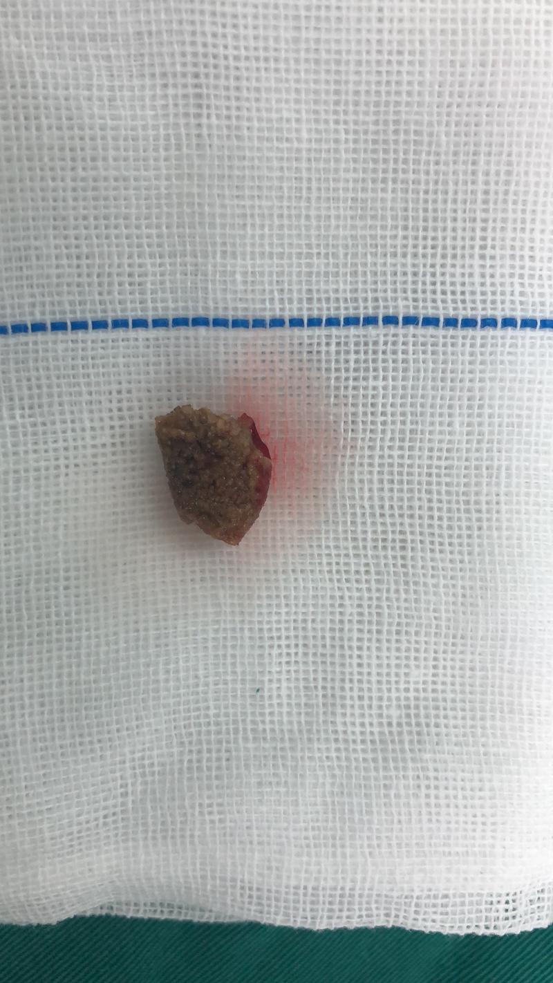 疼痛剧烈难忍,直冒冷汗,而后还出现恶心,呕吐,上洗手间时排出洗肉水样