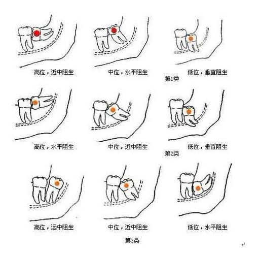 "智齿"给人带来多少痛苦?