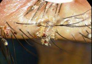 阴虱对人体有什么危害呢 得了阴虱怎么办