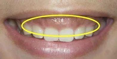 牙龈上有白点是怎么回事大病要来了吗