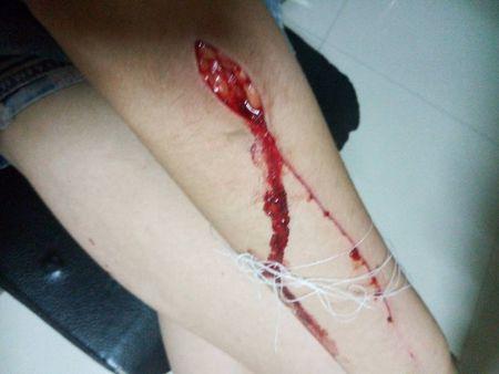 和别人打架了被别人用刀在胳膊上用刀划了一道长四公分深有一公分多的